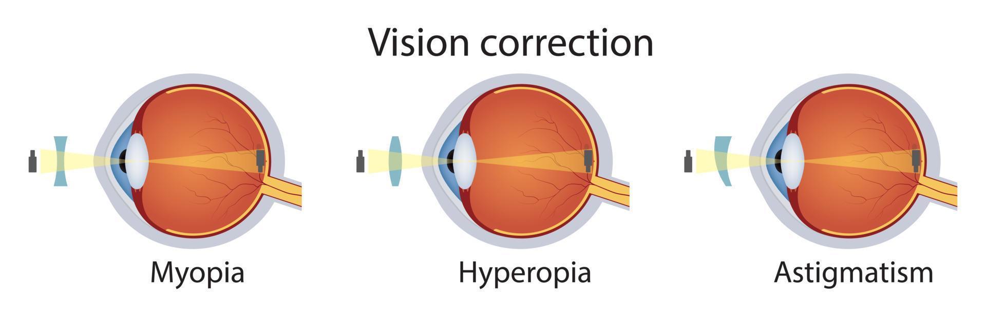 Correction of various eye vision disorders by lens. Hyperopia, myopia, astigmatism. Vector illustration