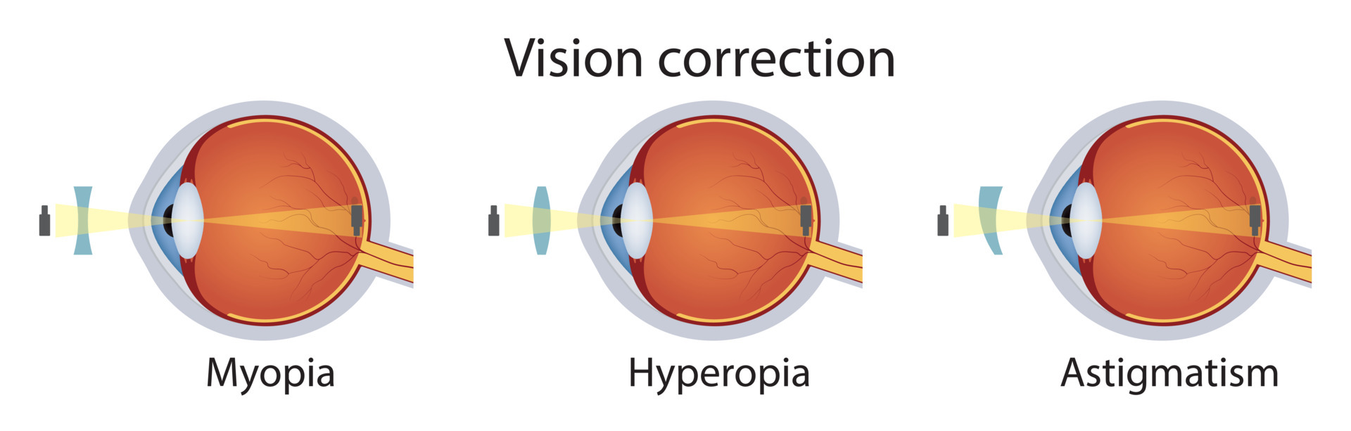 Correction of various eye vision disorders by lens. Hyperopia, myopia