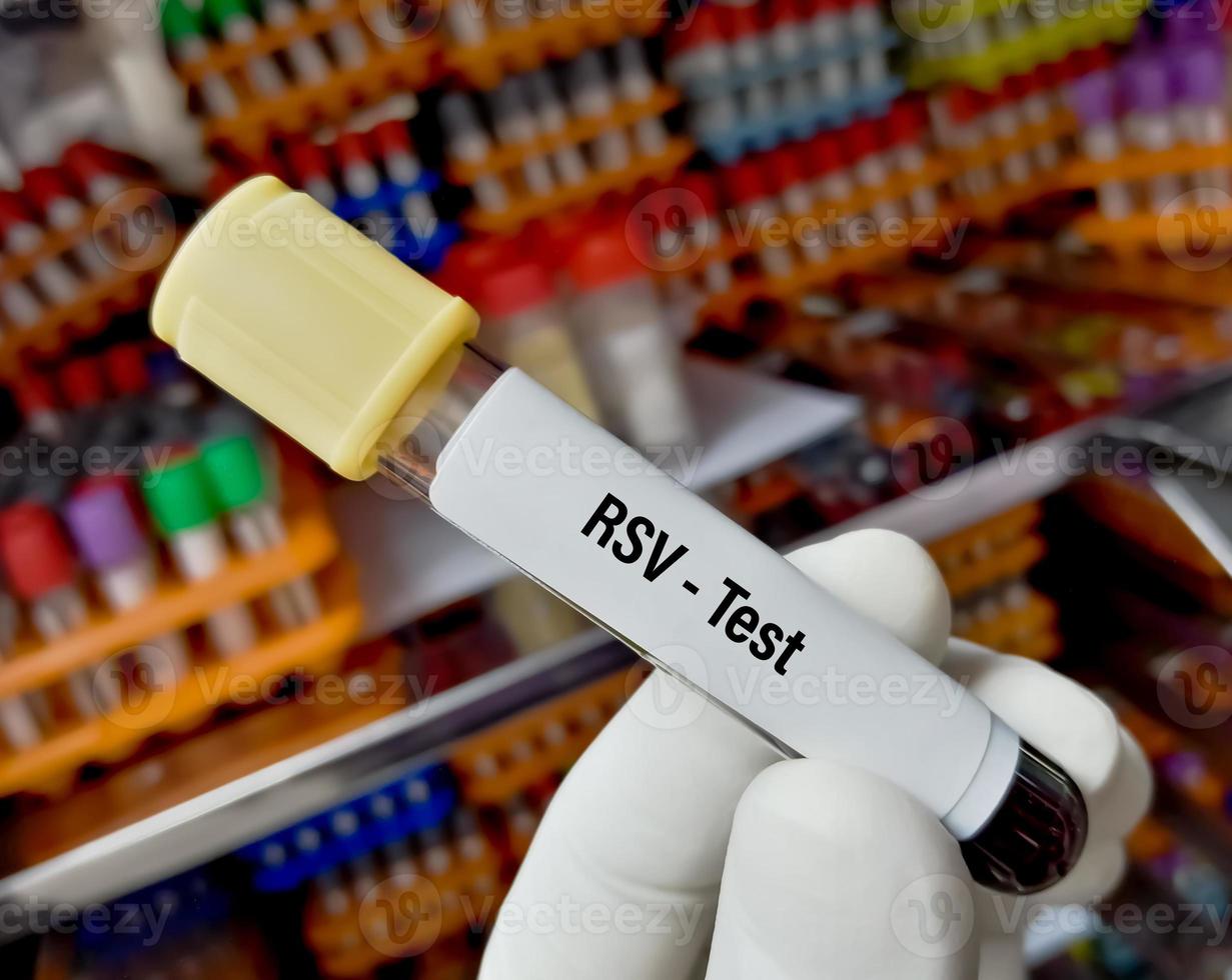Blood sample for respiratory syncytia test. RSV photo