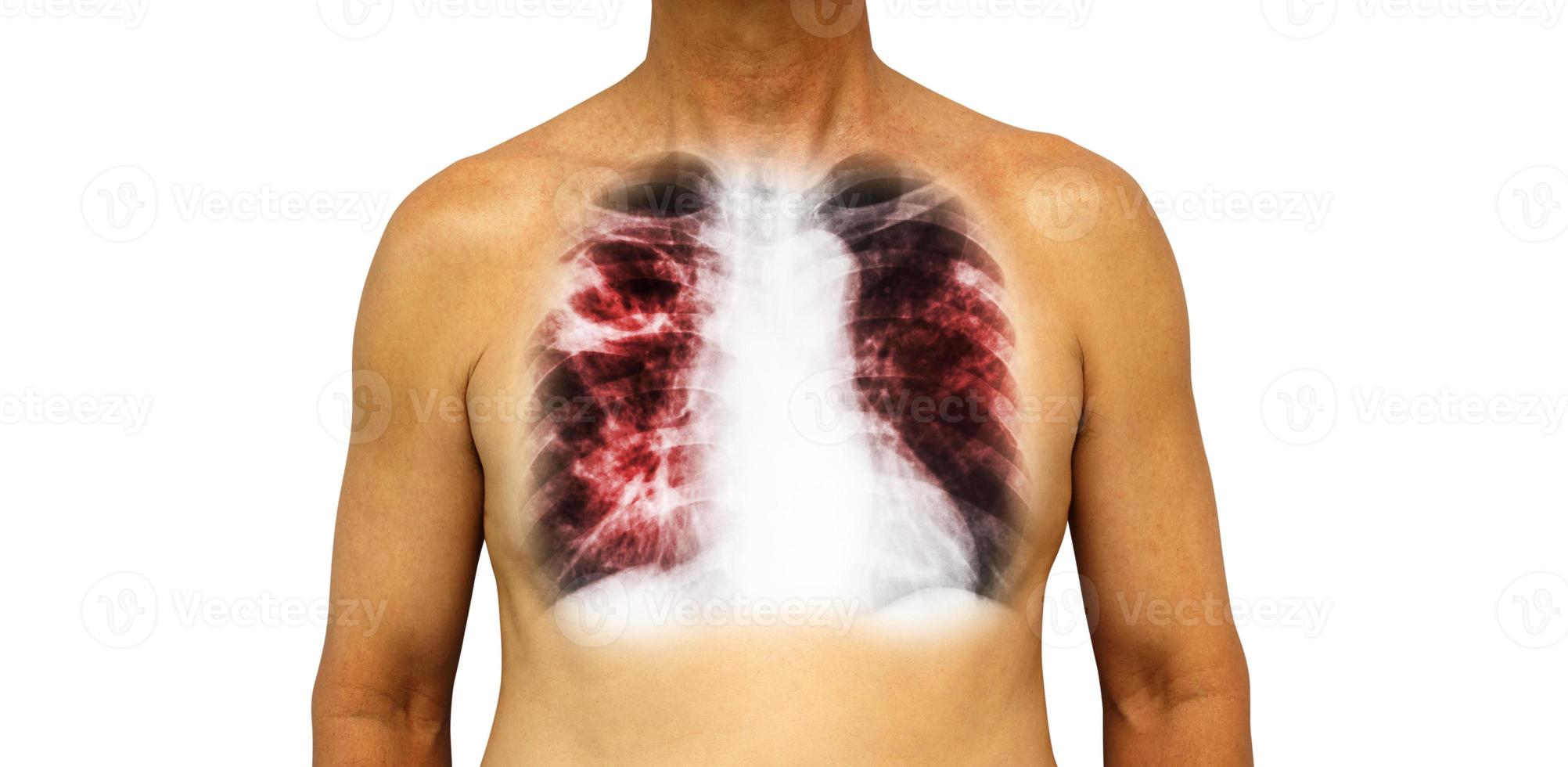 Pulmonary tuberculosis . Human chest with x-ray show cavity at right upper lung and interstitial infiltrate both lung due to infection . Isolated background photo