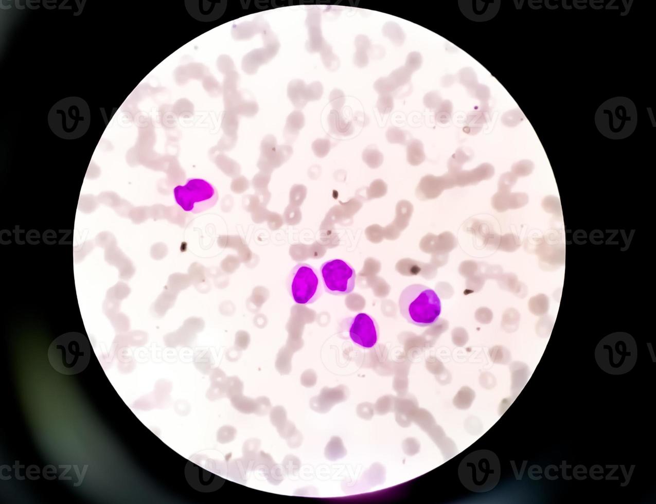 Microscopic view of thrombocytopenia-low platelet counts. hematology, 100X photo