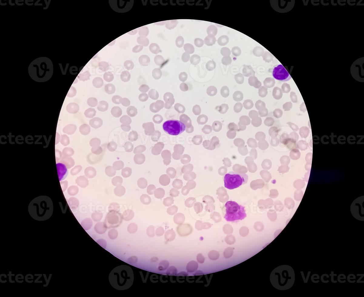 Myeloblasts with Auer rods seen in acute myeloid leukemia. photo