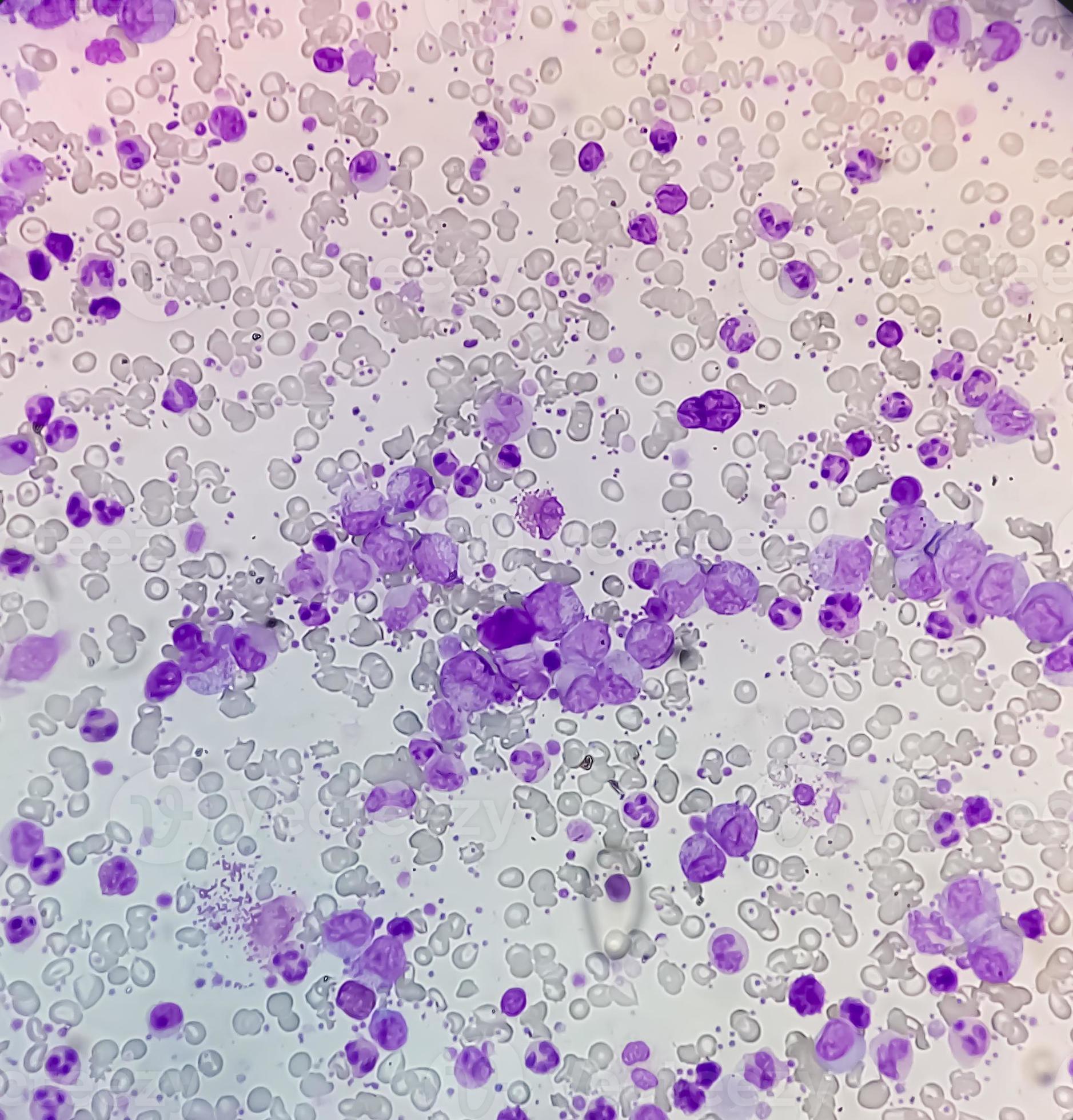 Eessential thrombocytosis blood smear showing abnormal high volume of
