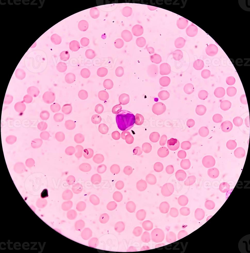 Microscopic view of Acute myeloid leukemia, myeloblastic Leukemia, a ...