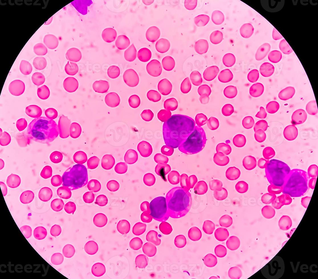 Microscopic view of Acute myeloid leukemia, myeloblastic Leukemia, a cancer of white blood cells. 100x photo
