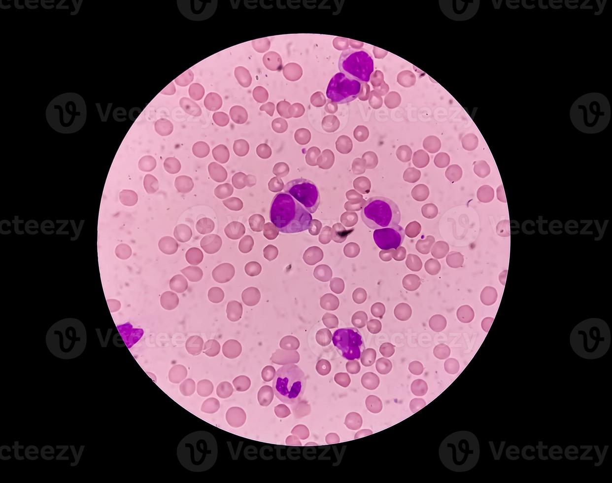 vista microscópica de la leucemia mieloide aguda. leucemia mieloblástica, un cáncer de glóbulos blancos, 40x. aml foto