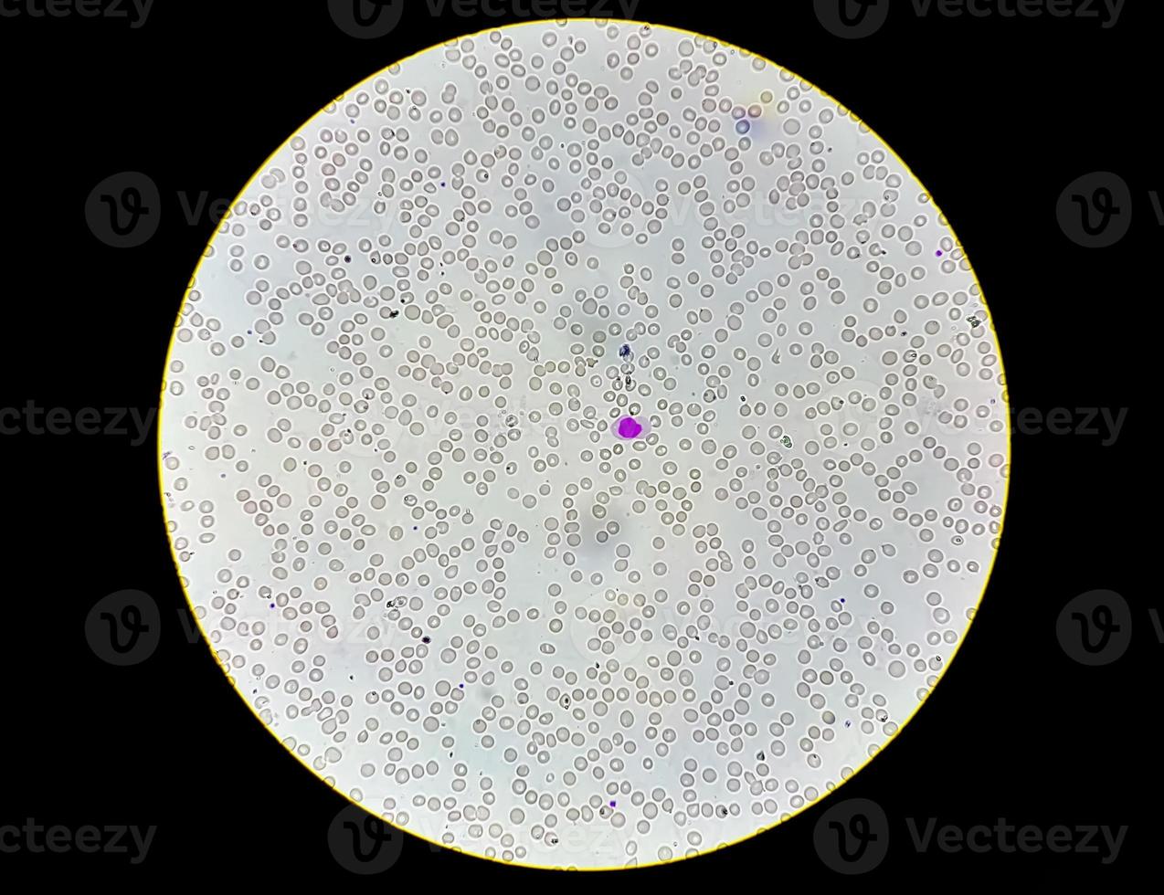 Photomicrographic view of abnormal hematological slide. 10X photo