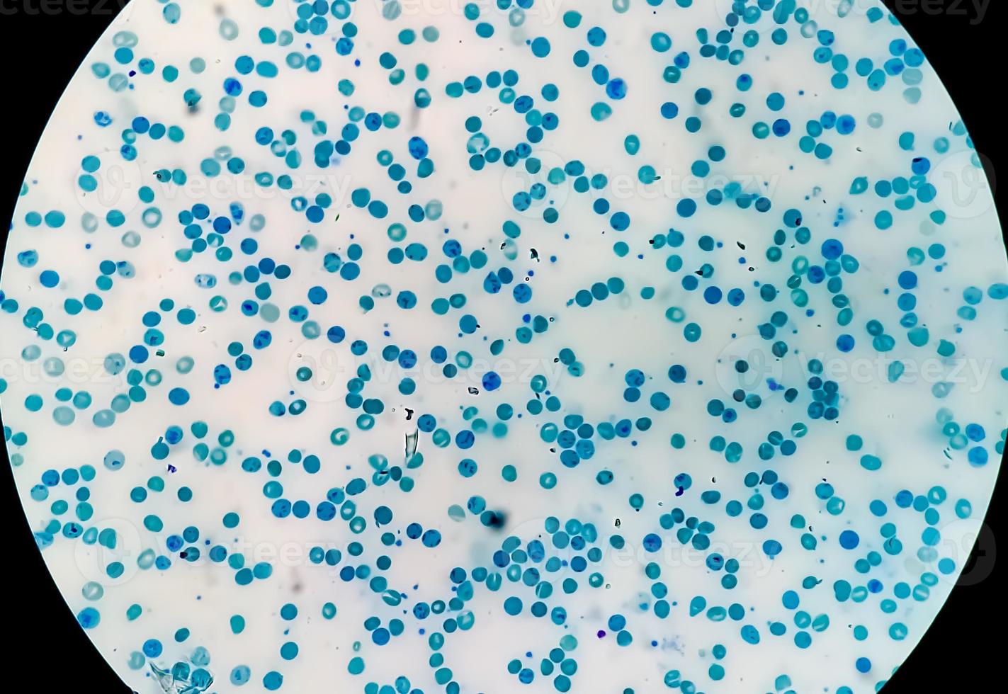 Vista microscópica cercana del recuento anormal de reticulocitos en el departamento de hematología, tinción con azul de metileno foto