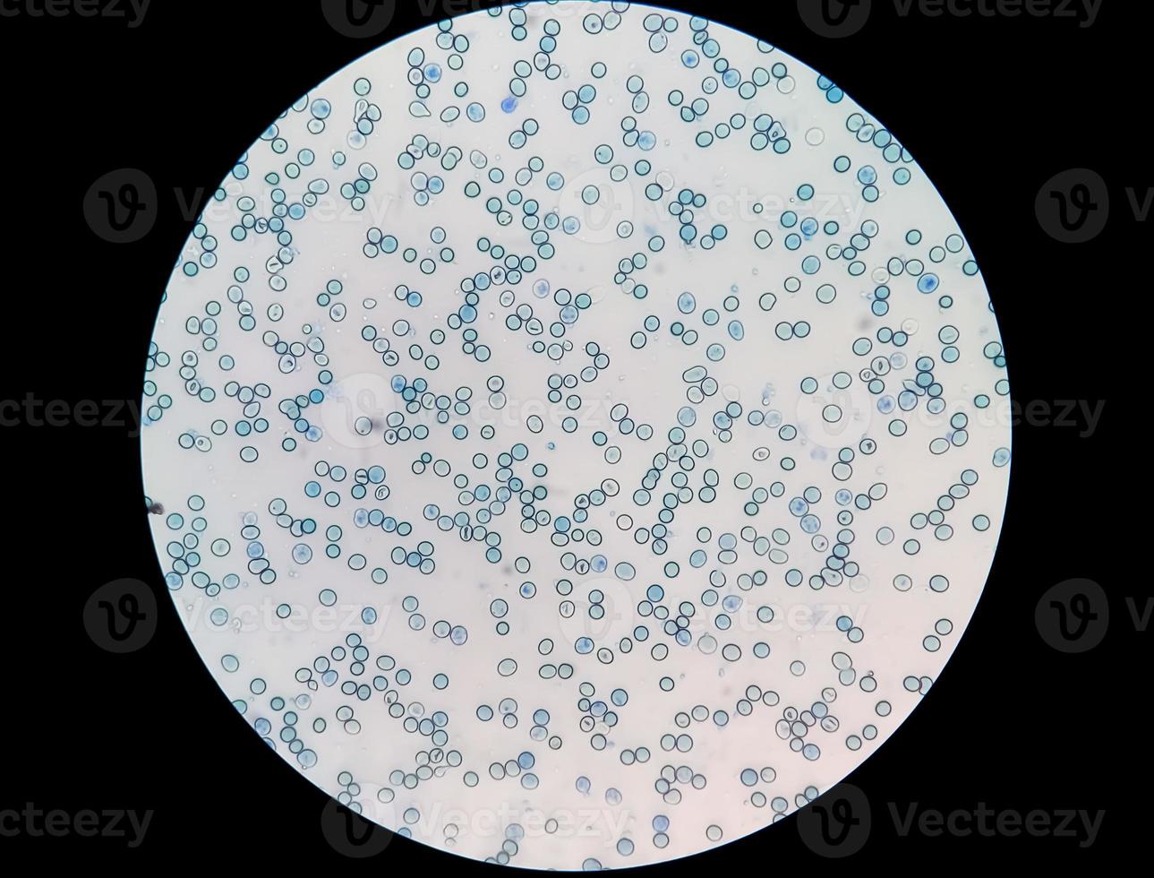 Close microscopic view of abnormal reticulocyte count in hematology department, methylene blue staining photo