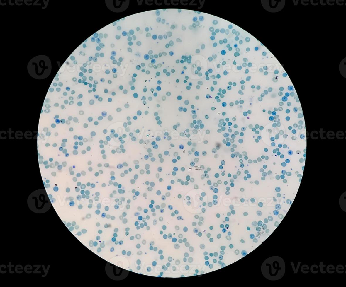 Vista microscópica cercana del recuento anormal de reticulocitos en el departamento de hematología, tinción con azul de metileno foto