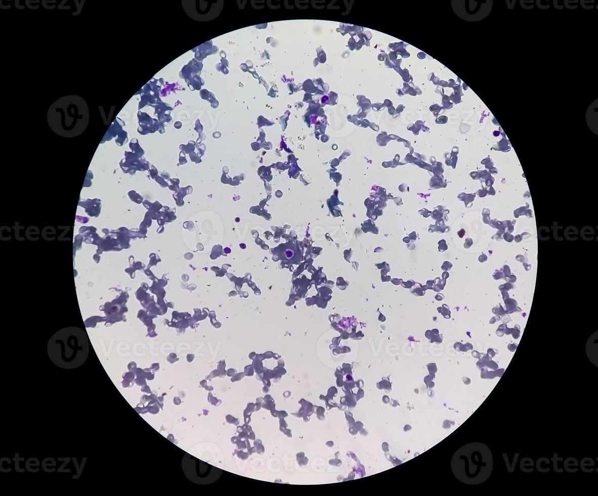Microscopic view of cold agglutinin disease. autoimmune hemolytic anemia. CAD photo