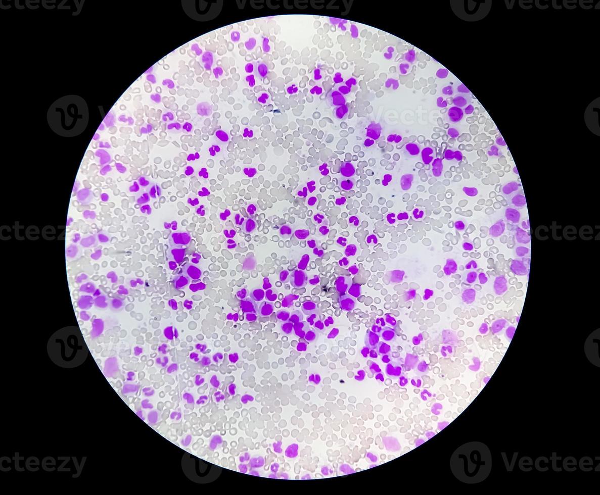 Microscopic view of hematological stained slide. thrombocytopenia photo