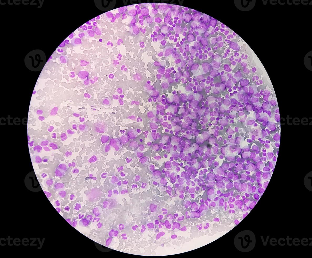 Microscopic view of thrombocytopenia with leukocytosis. hematology photo