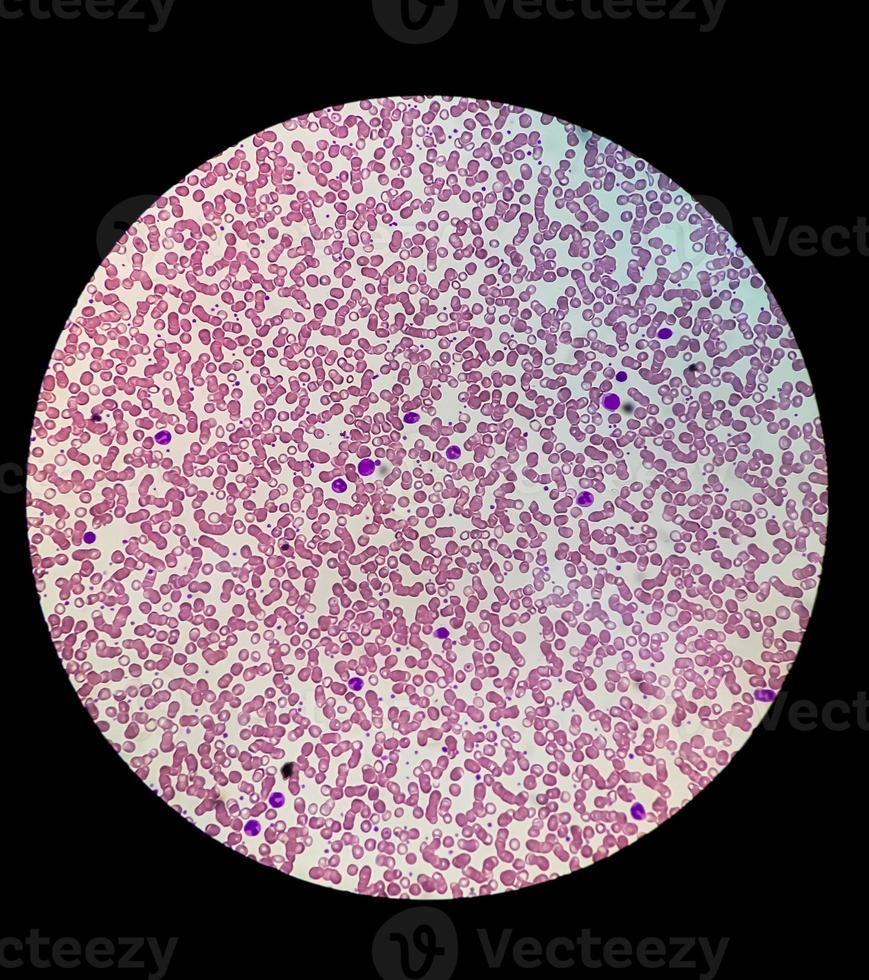 Microscopic view of stained slide of Hematology in laboratory. close up. total blood count