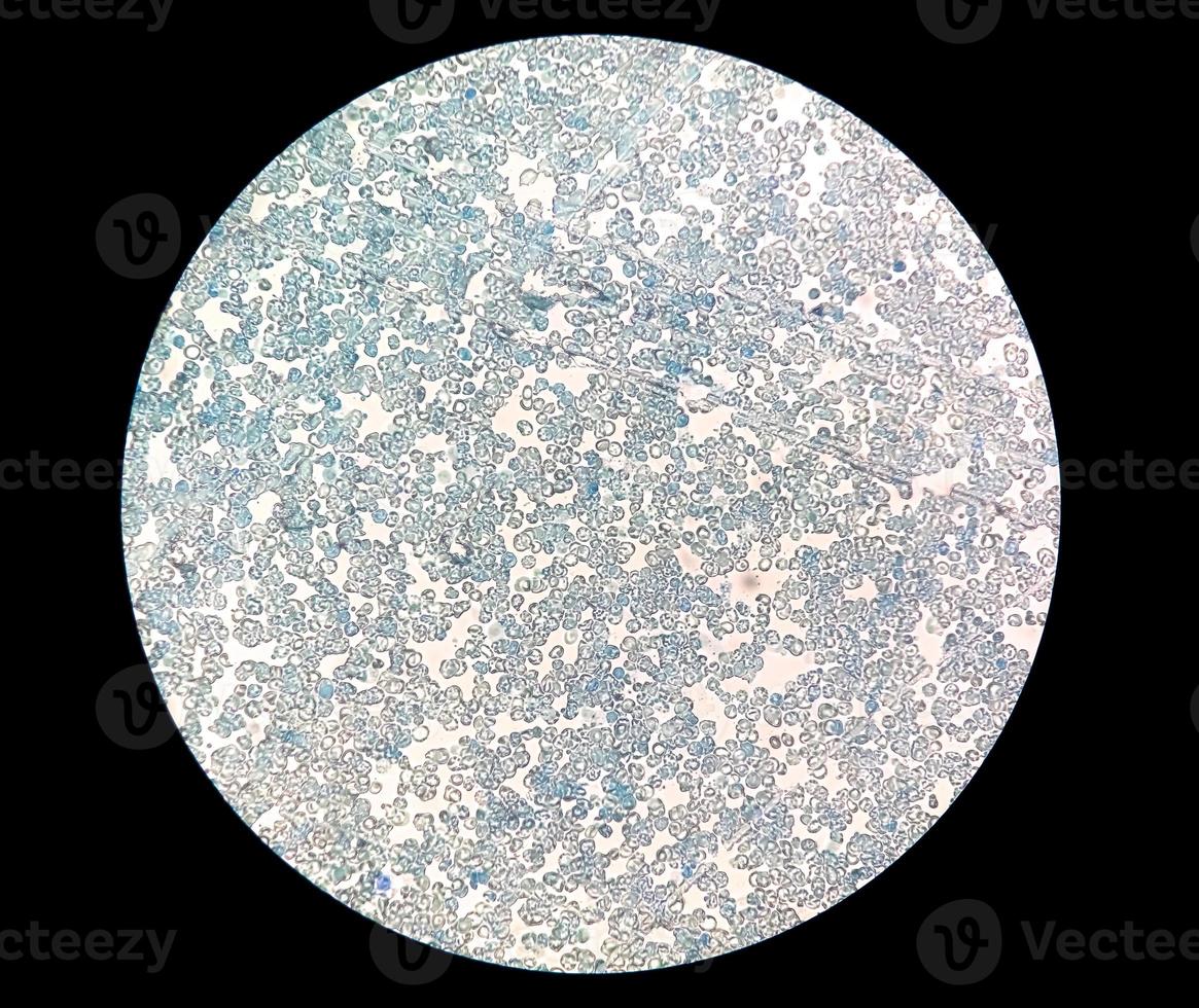 Close microscopic view of abnormal reticulocyte count in hematology department, methylene blue staining photo