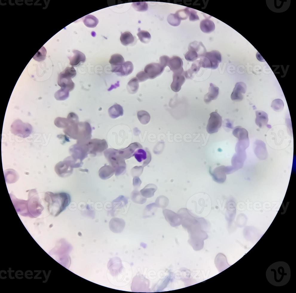 Microscopic view of cold agglutinin disease. autoimmune hemolytic anemia. CAD photo