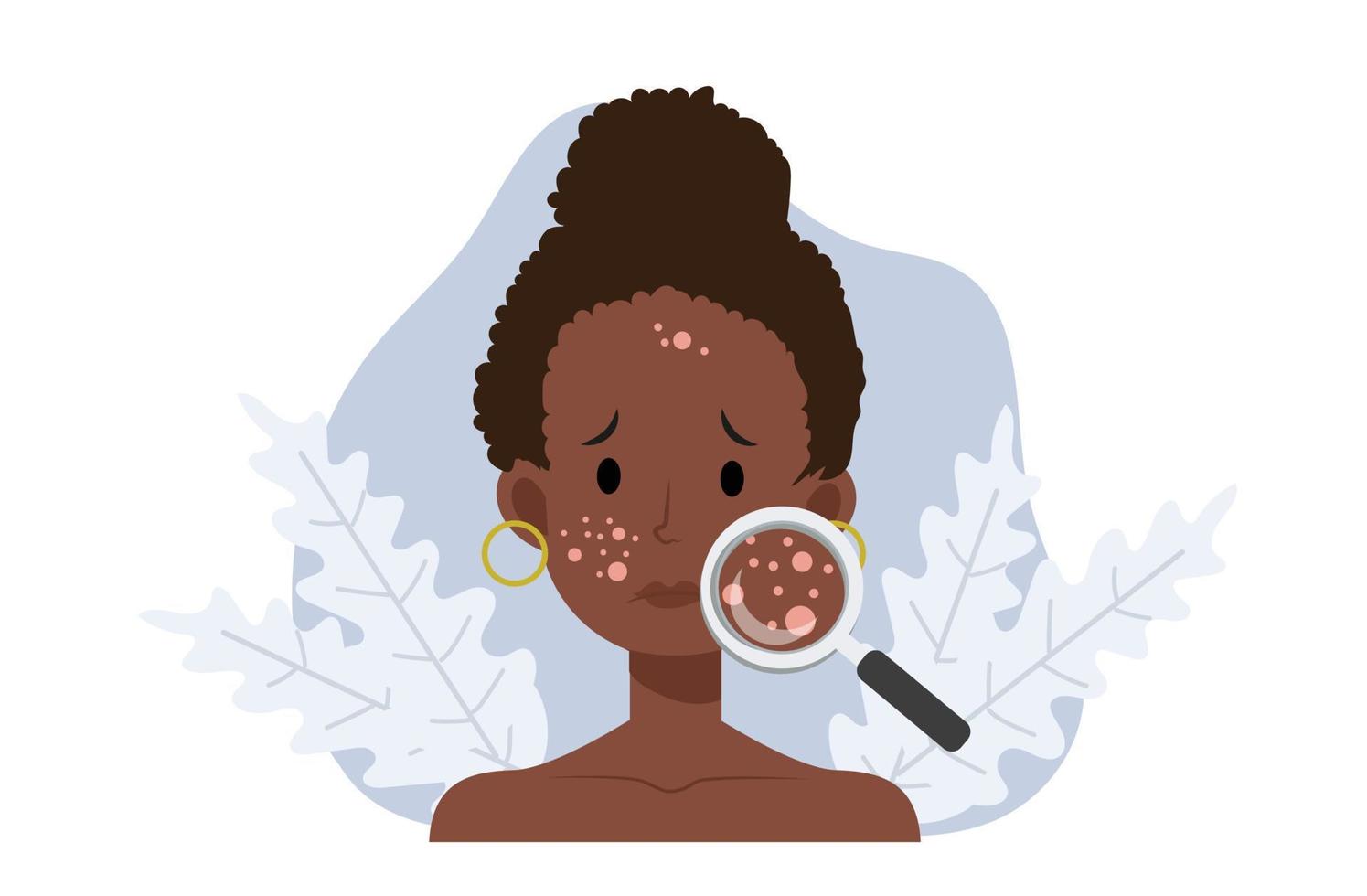 Acne skin problems Concept.African american woman with magnifying glass is looking acne on his facial. Falt vector cartoon illustration.