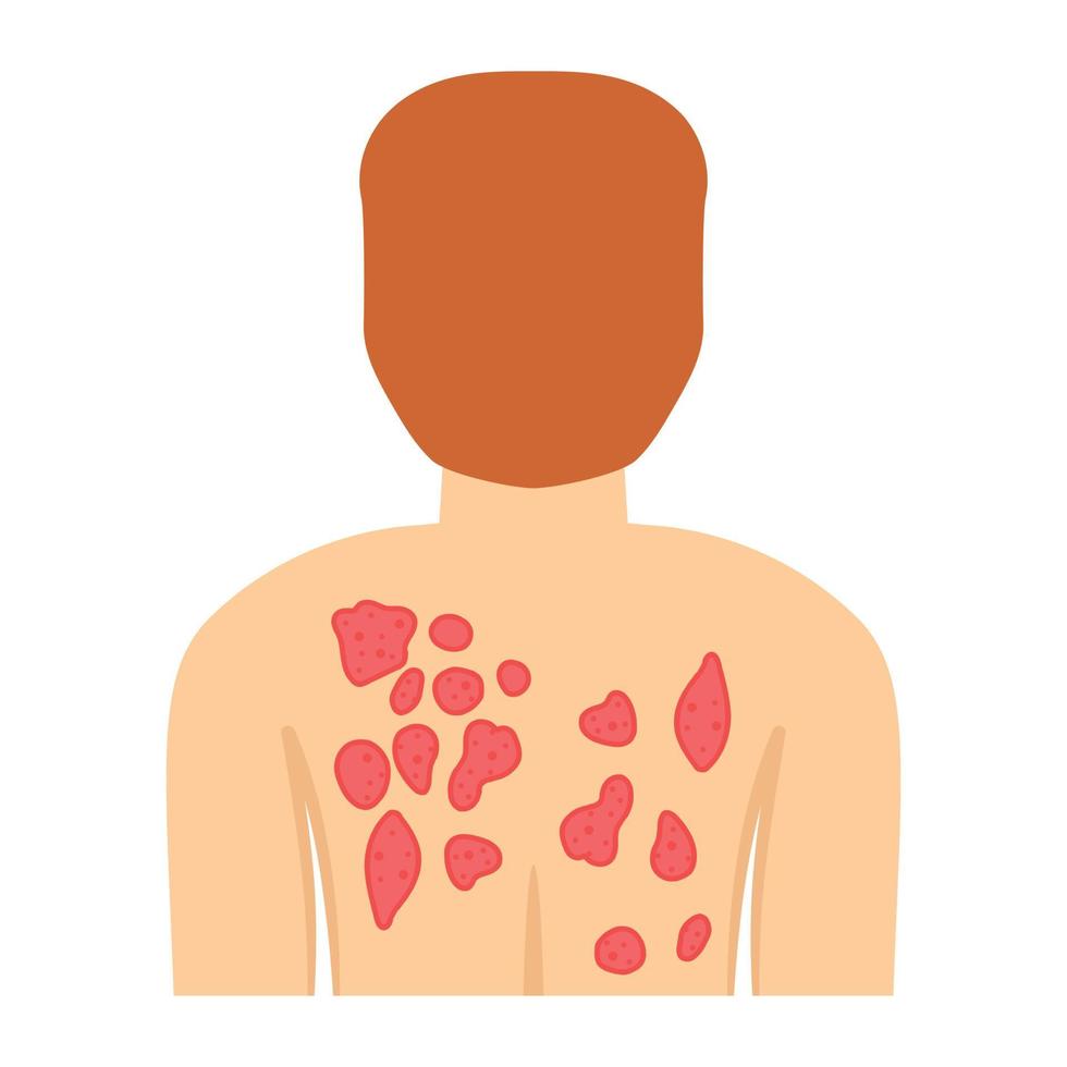 Editable design of body rashes vector