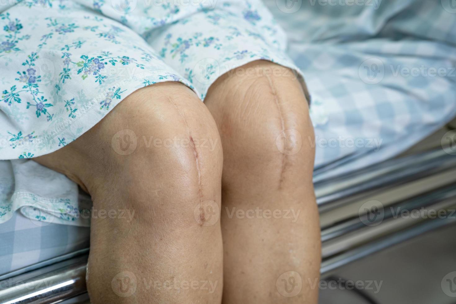 Asian senior or elderly old lady woman patient show her scars surgical total knee joint replacement Suture wound surgery arthroplasty on bed in nursing hospital ward, healthy strong medical concept. photo