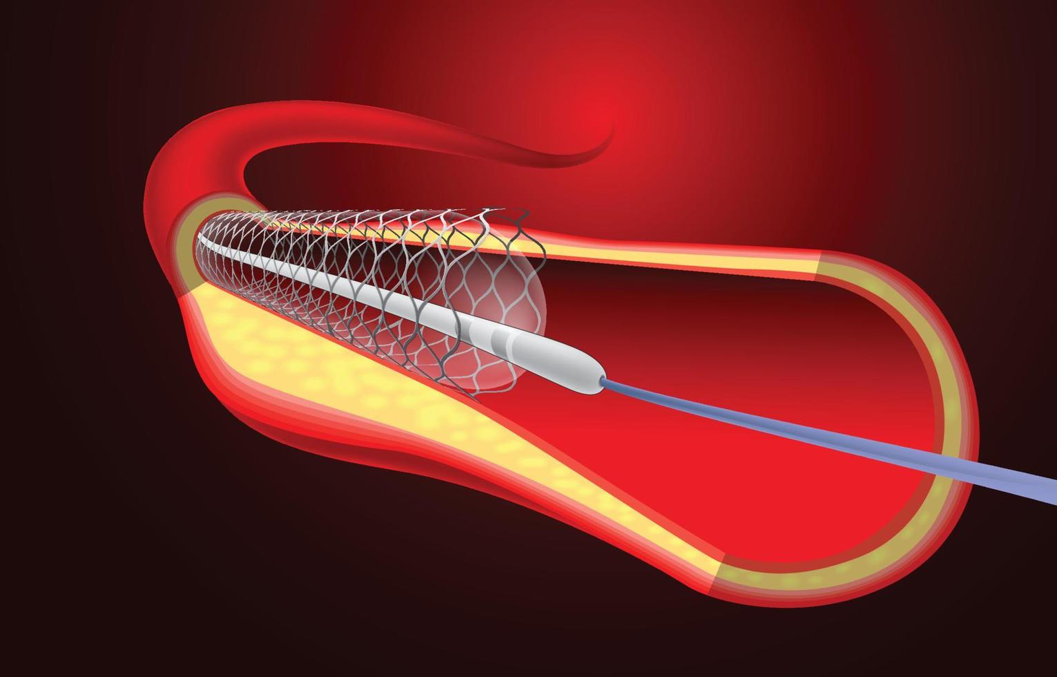 ilustración de la implantación de un stent para ayudar al flujo de sangre a los vasos sanguíneos. vector