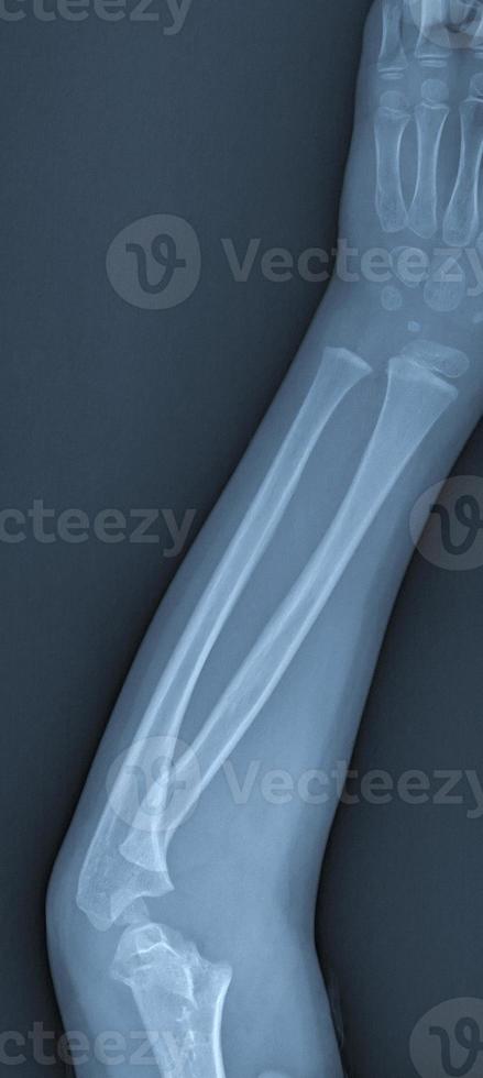 Broken arm xray photo