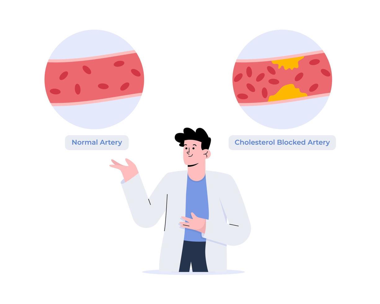 A doctor explained about normal and cholesterol blocked artery vector