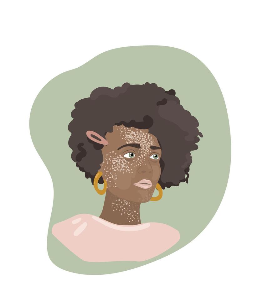 Girl with vitiligo syndrome. A girl with dark skin and curly hair. vector