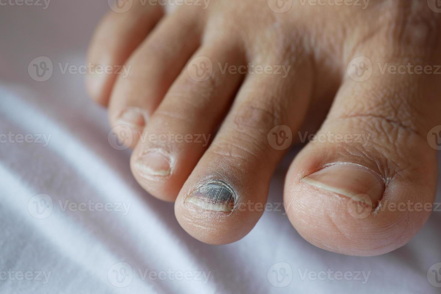 close up of women's infected feet fingers on bed , photo