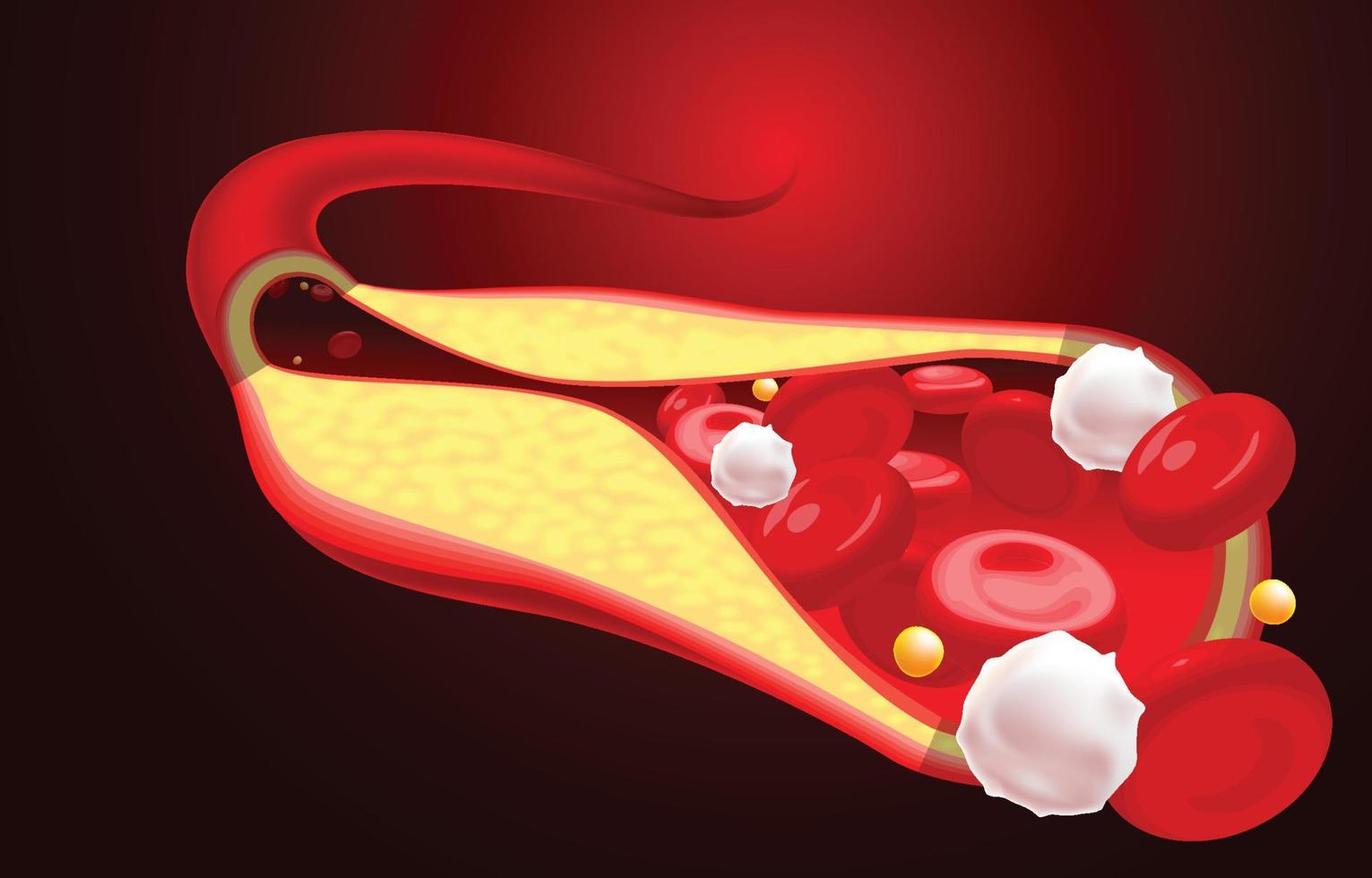 Red blood cell and cholesterol blockage illustration vector