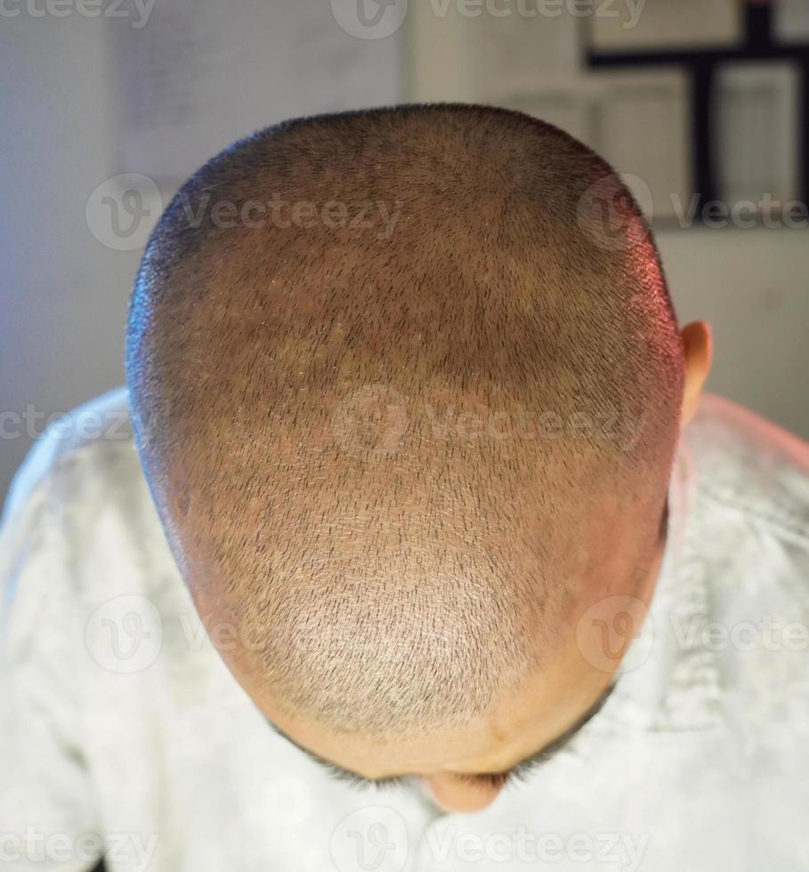 a head image after baldness photo