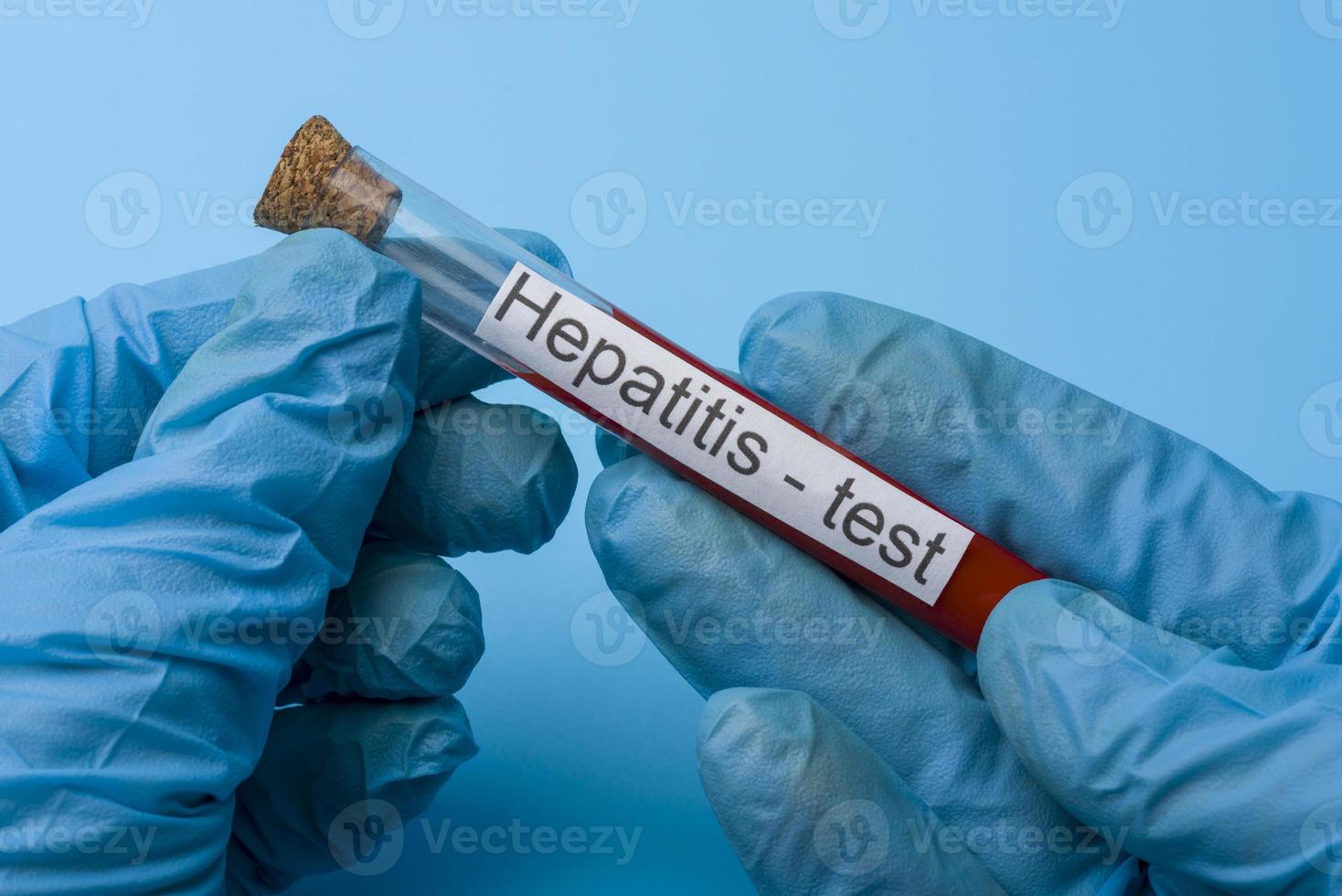 Hepatitis test, Blood in the test Tube. photo