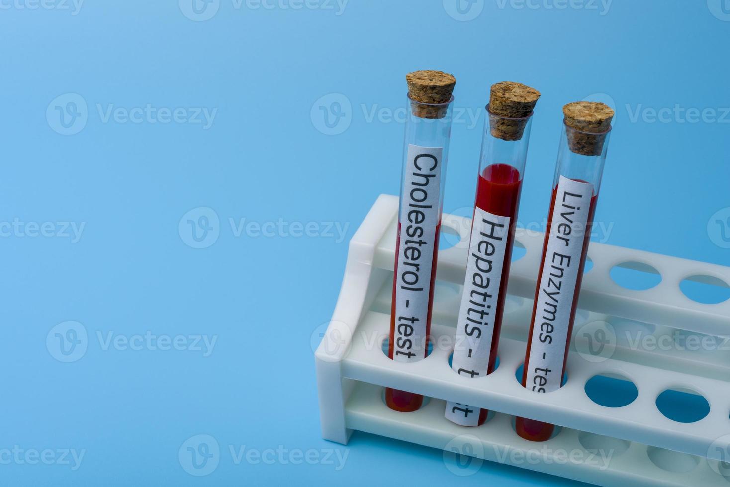 Cholesterol test Hepatitis Test and liver Enzyme Test, in Vitro. photo