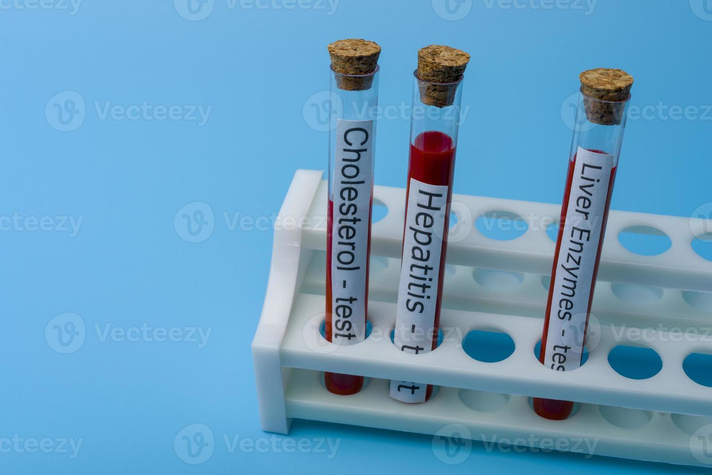 Cholesterol test Hepatitis Test and liver Enzyme Test, in Vitro. photo