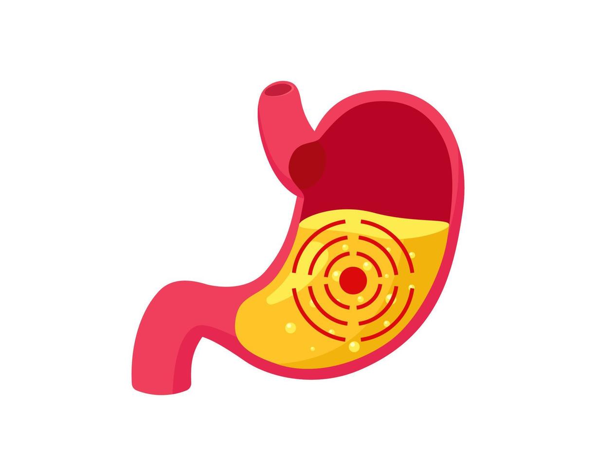 Stomach ulcer with gastric juice inside and target. Digestive system gastritis problem. Indigestion and belly disease. Abdominal gastric pain. Medical vector eps illustration