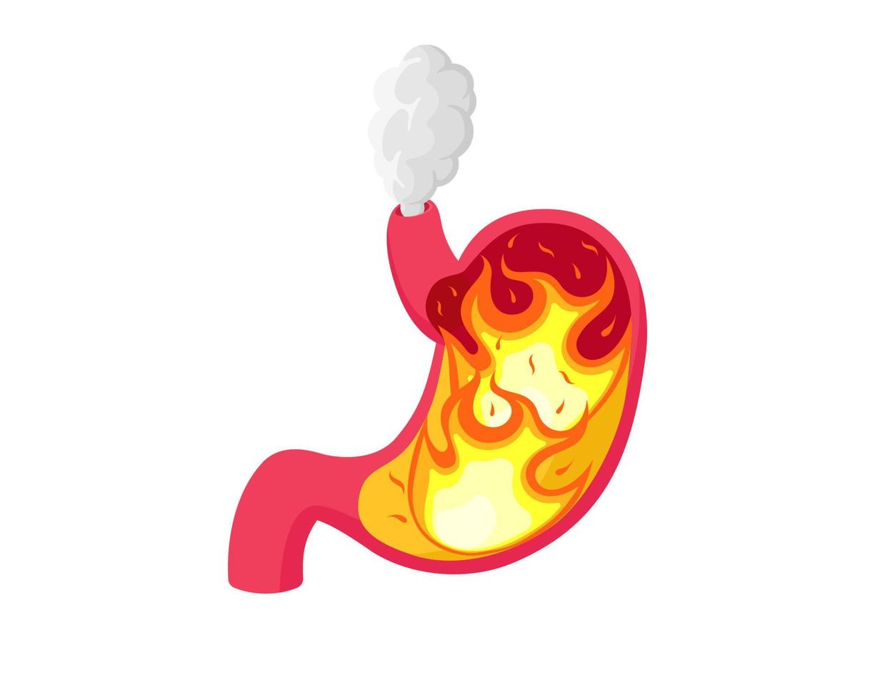 Stomach heartburn with burning acid inside. Digestive system gastritis problem. Indigestion and belly disease. Abdominal gastric pain from fire. Gastroesophageal reflux vector eps illustration