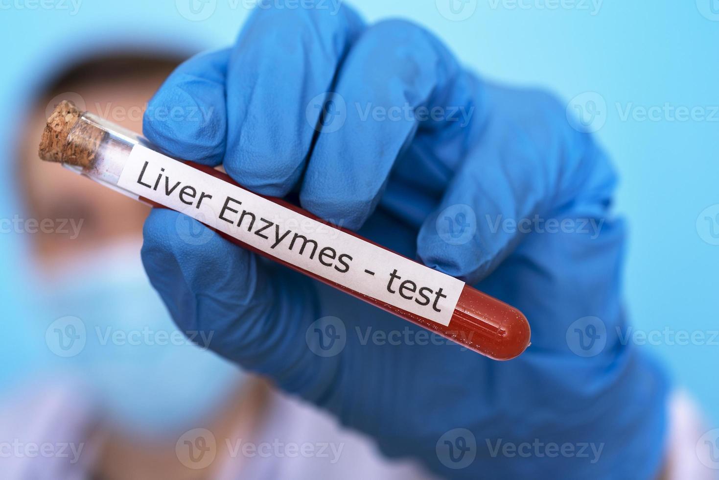 A hand in a medical glove holds a flask for a test for liver enzymes. photo