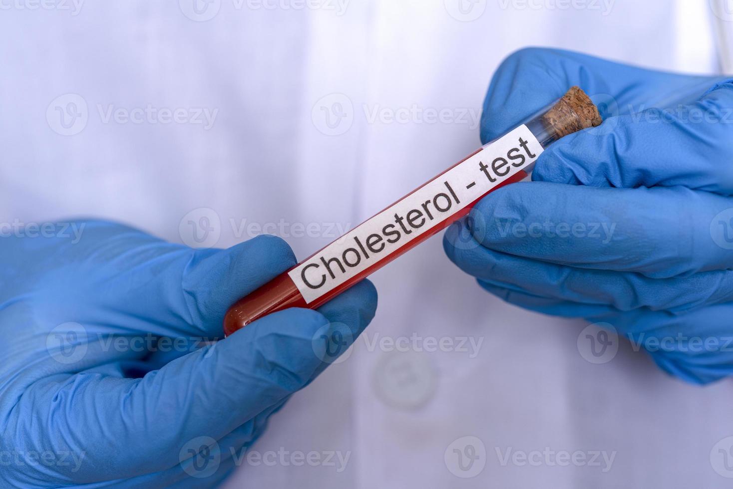 Hands in medical gloves hold a flask of blood for a cholesterol test. photo