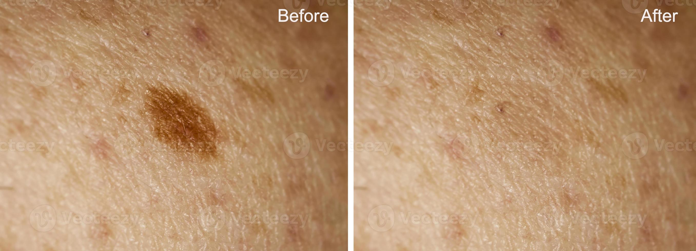 Photo before and after removal of large mole on woman's skin. Selective focus. Mole removal concept