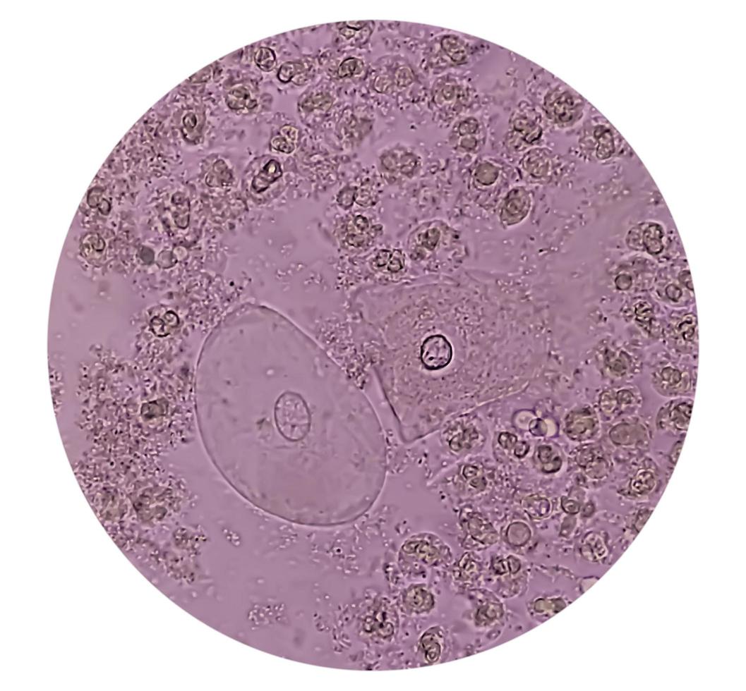 Microscopic image show plenty Pus cells with few Epithelial cells. Urinary tract infection. Pyuria.40X photo