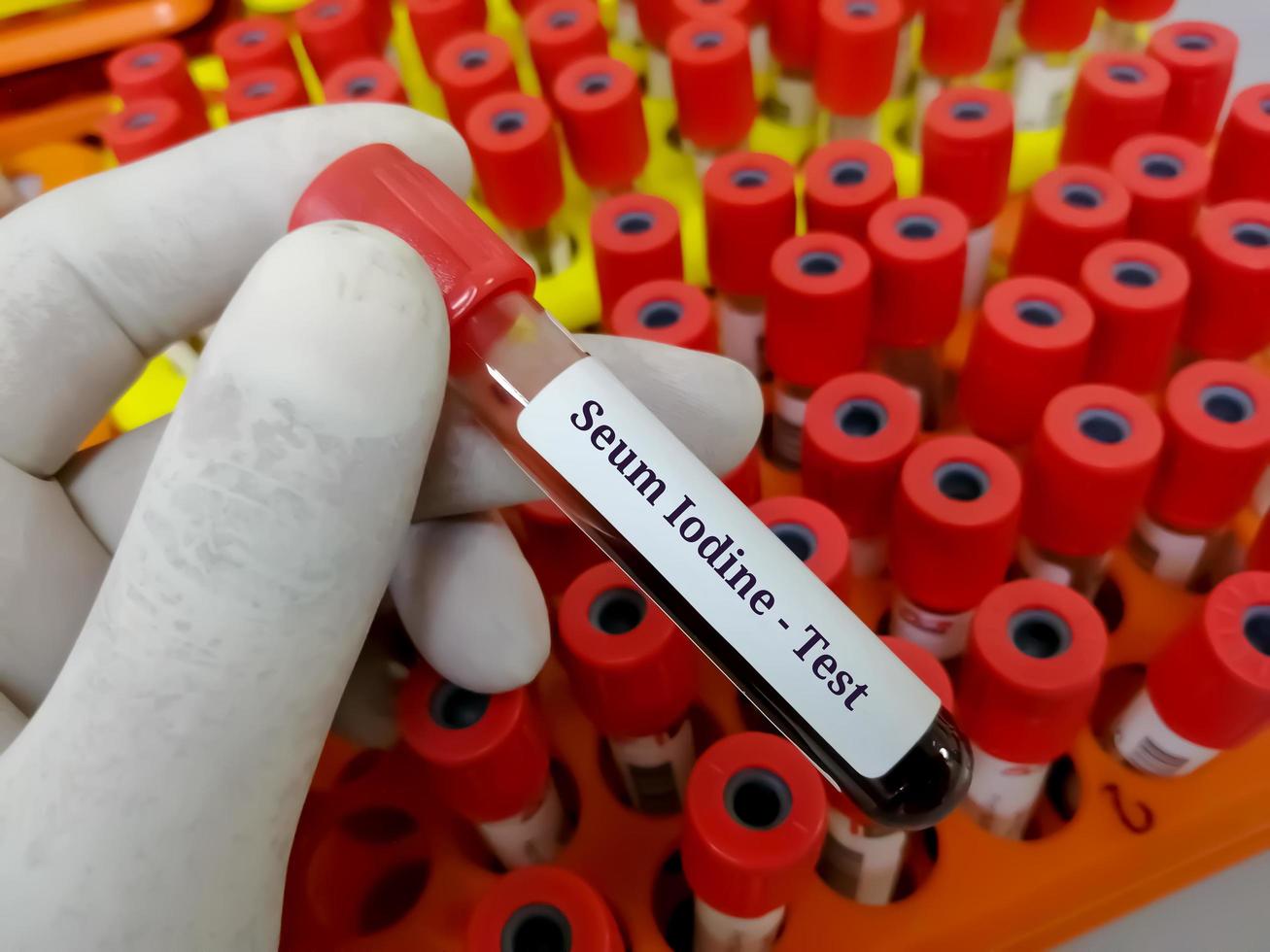 Blood sample for Iodine test. diagnosis of iodine deficiency or excess, iodine-induced hyperthyroidism and hypothyroidism. photo