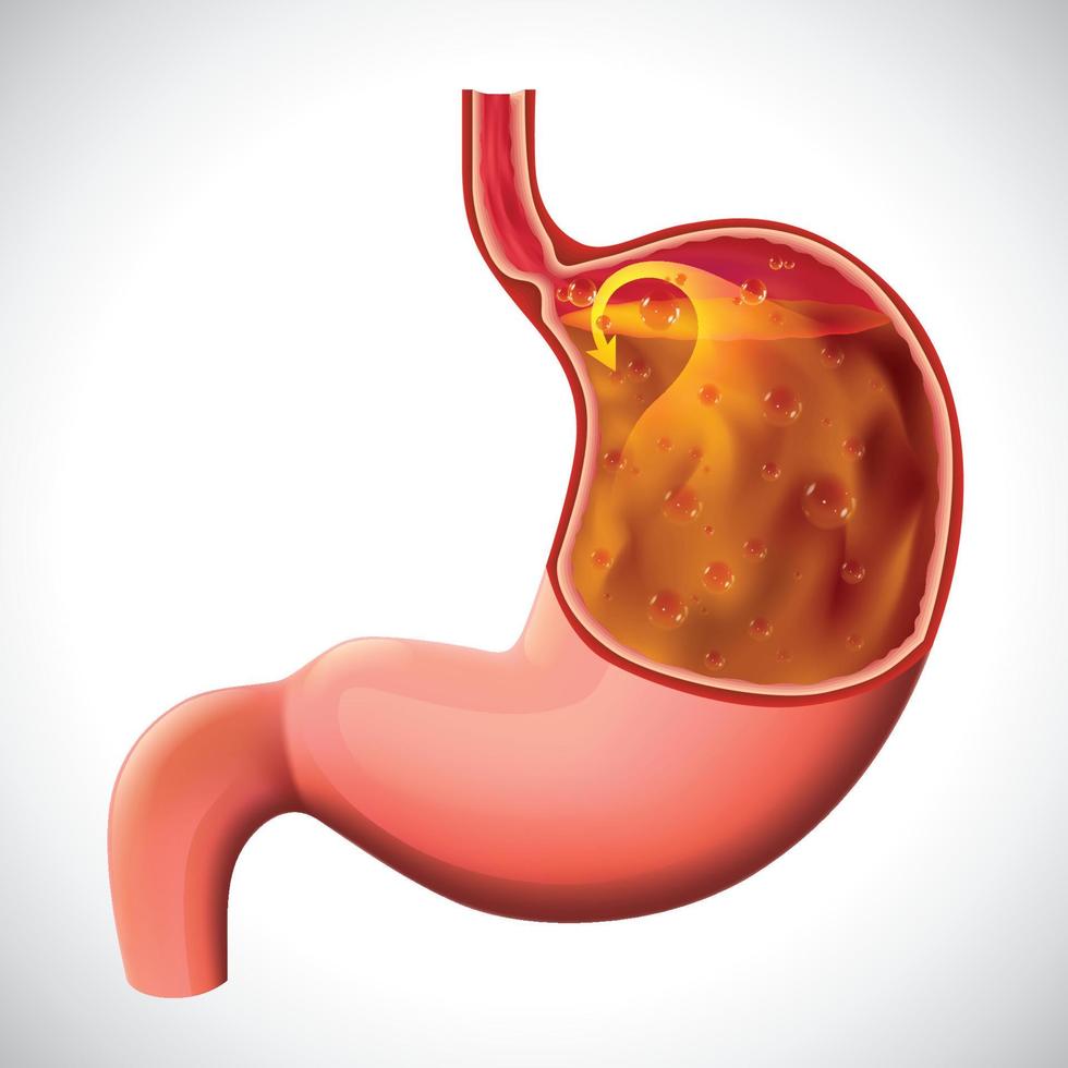 gastroesophageal reflux disease illustration for medical and educational use. vector