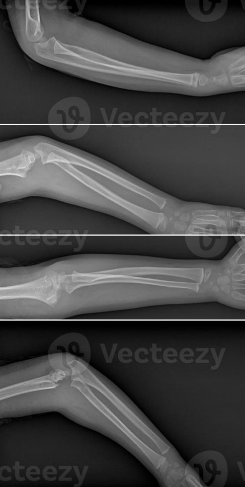 Broken arm xray photo
