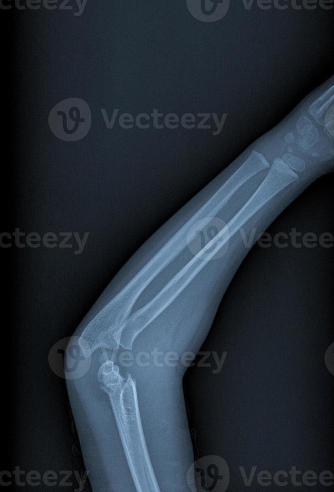 Broken arm xray 5388832 Stock Photo at Vecteezy