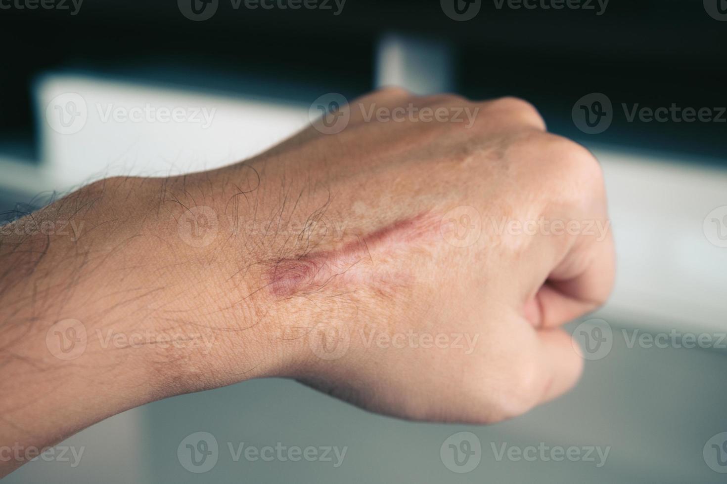 cicatriz en la piel humana queloide en la mano. foto