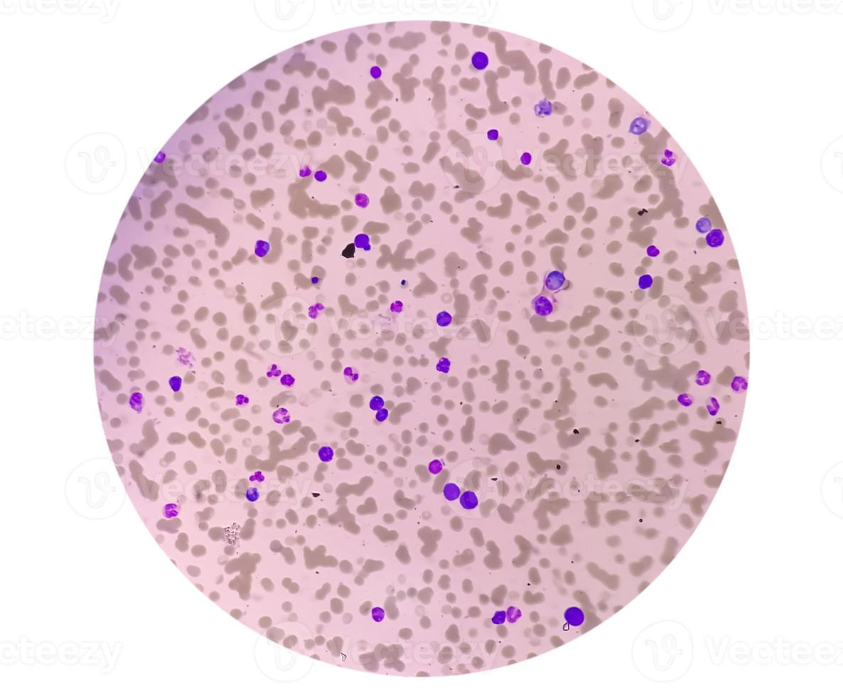 Photomicrograph of Plasma cell leukemia or Waldenstrom macroglobulinemia, a rare type of white blood cell Cancer photo