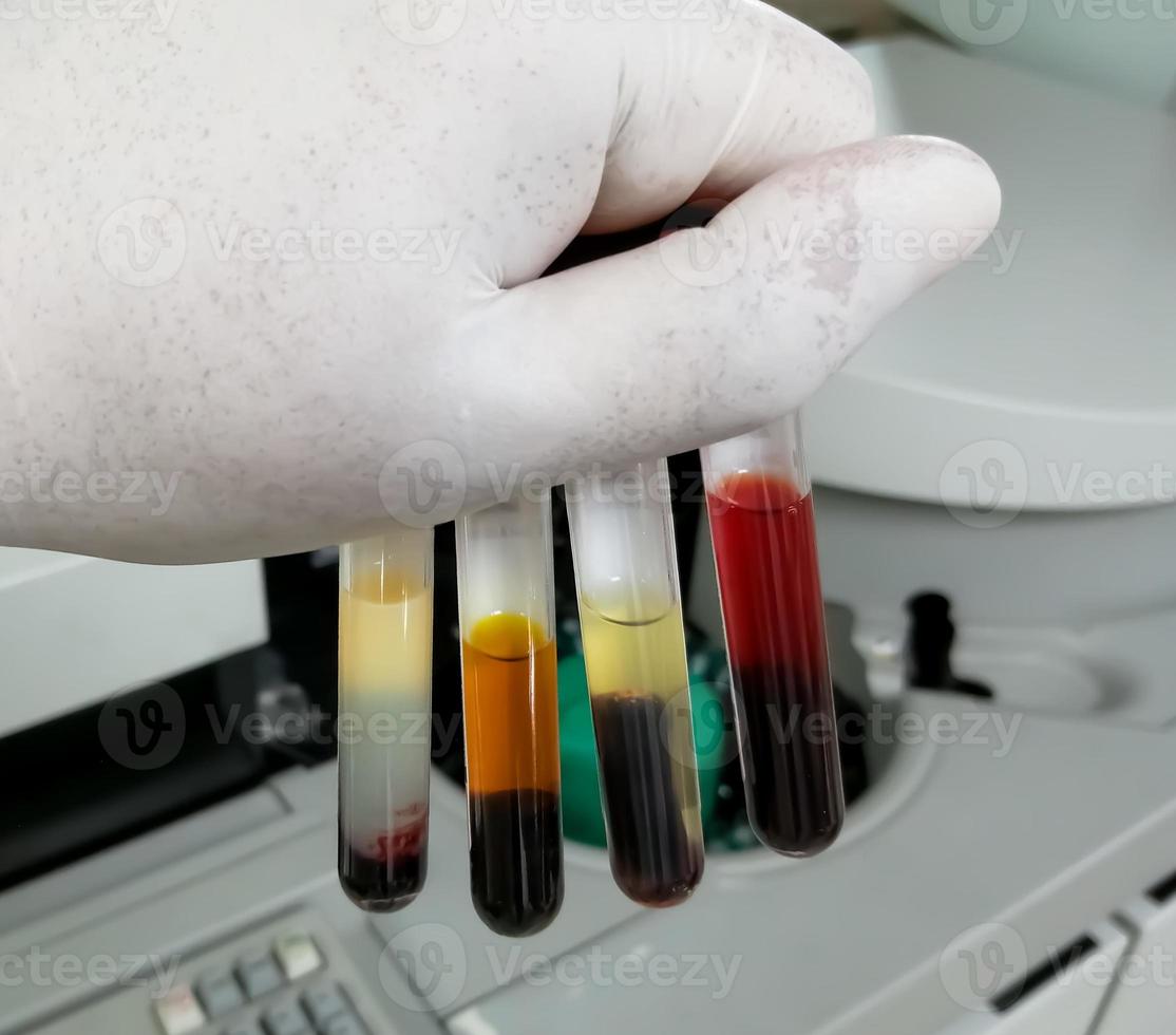 Scientist hand hold Common types of blood serum sample errors. Different types of sample which interfere test result. photo