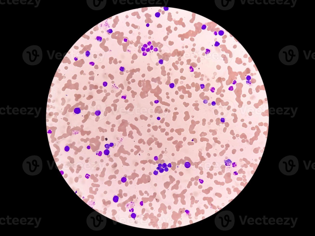 Microscopic image of Plasma cell leukemia or Waldenstrom macroglobulinemia. photo