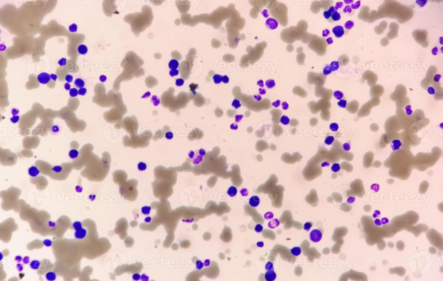 Photomicrograph of Plasma cell leukemia or Waldenstrom macroglobulinemia, a rare type of cancer that begins in the white blood cells photo