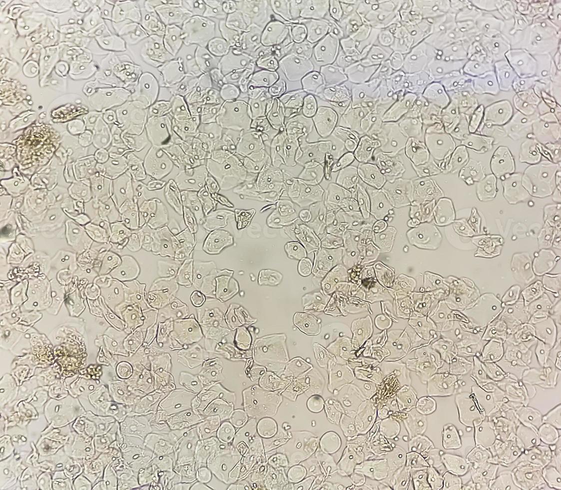 Photomicrographic close view of Abnormal urine analysis with copy space. Epithelial cell, Pus cell. photo