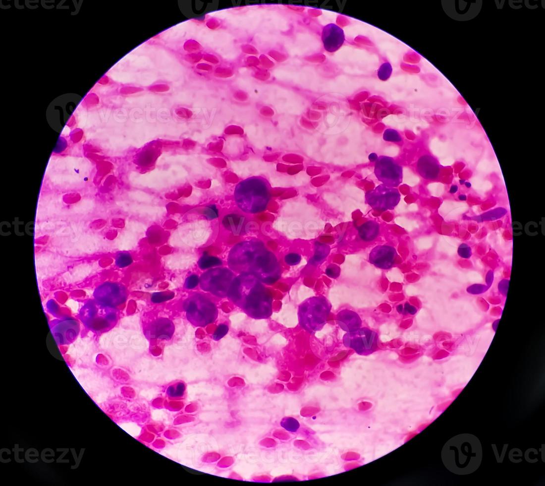 Photomicrograph of Metastatic adenocarcinoma of lung photo